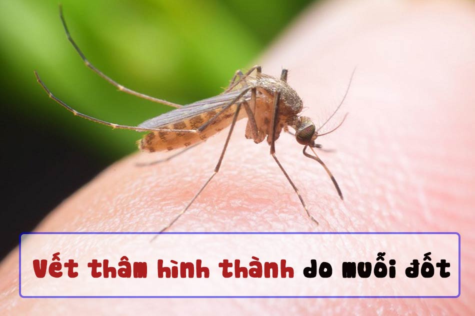 Bé bị MUỖI ĐỐT sưng to bôi gì Nguyên nhân và cách xử lý vết muỗi cắn