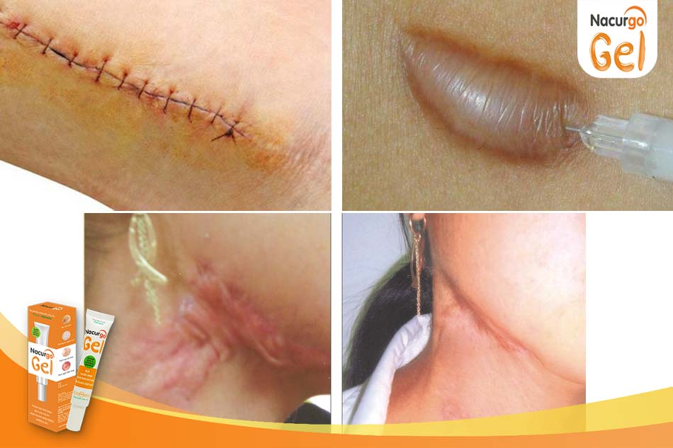 Phương pháp phẫu thuật sẹo lồi: Khâu thẩm mỹ - Tiêm corticoid - Hình ảnh sau khi ghép da tự thân 